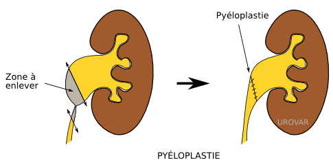 Pyeloplastie