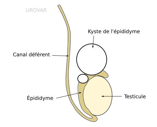 Kyste de l'épididyme - Centre d'urologie Urovar