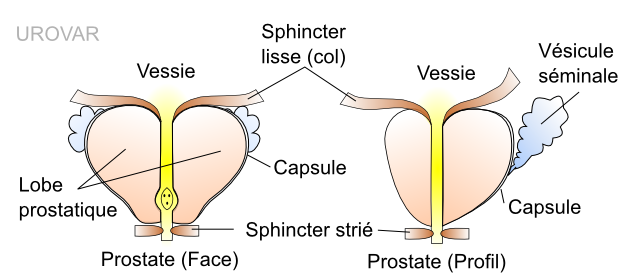 A prostatarák patológiája Prostate cancer gleason score 7 43