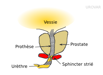 prothse prostate